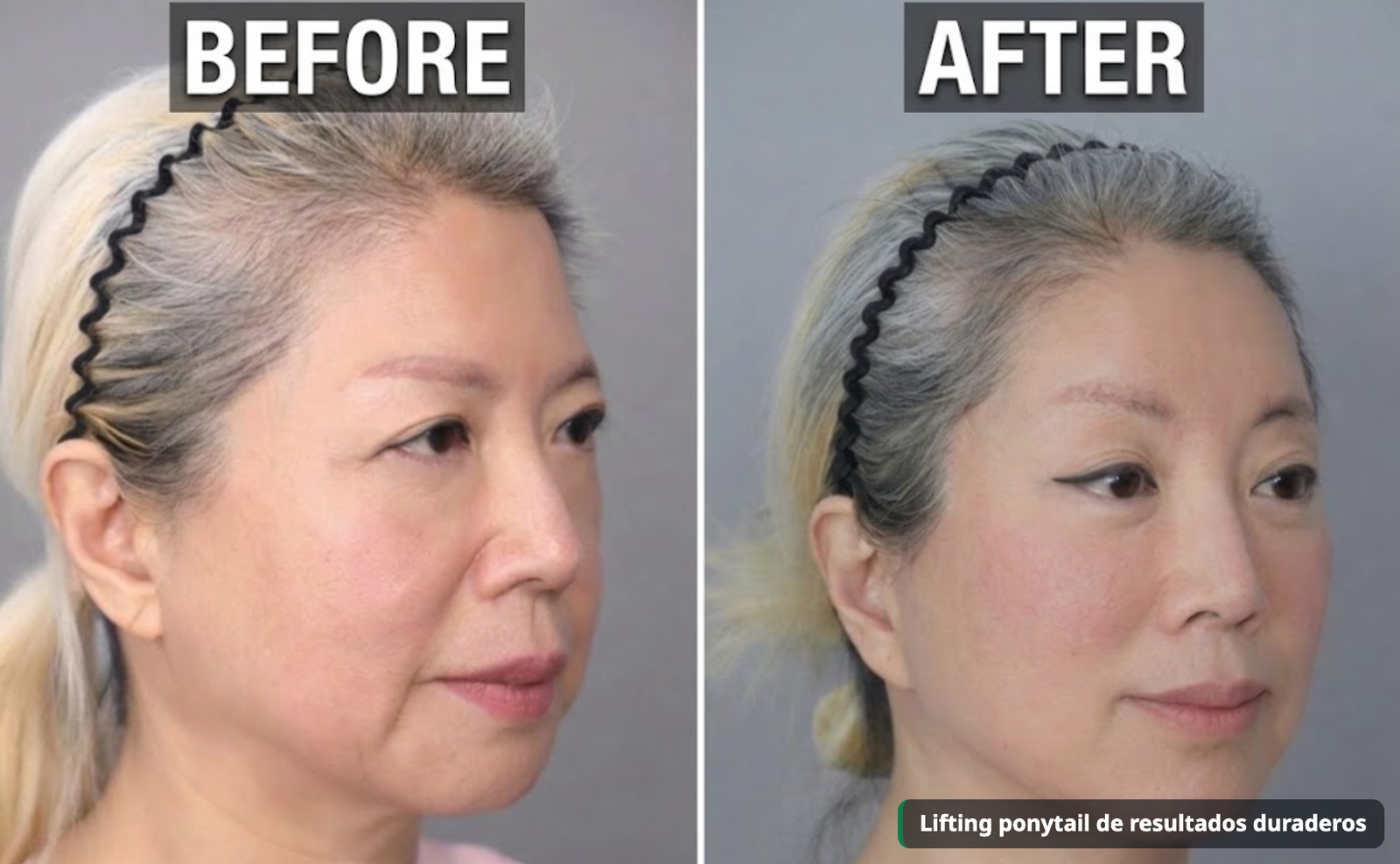 Antes y después de un lifting ponytail con liberación perióstica triple